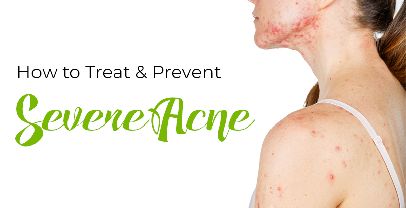 How to Treat & Prevent Severe Acne