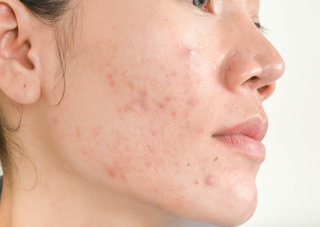 How to Treat & Prevent Moderate Acne