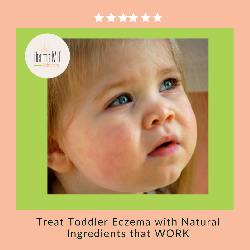 Treat Toddler Eczema with Natural Ingredients!